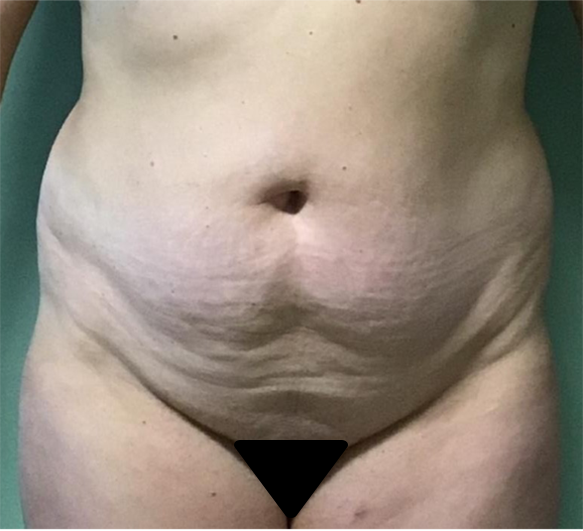 Tummy Tuck