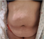 Tummy Tuck