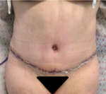 Tummy Tuck