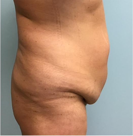 Tummy Tuck