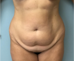 Tummy Tuck