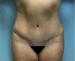 Tummy Tuck