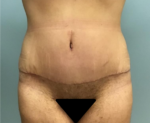 Tummy Tuck