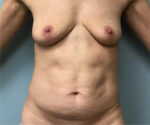 Tummy Tuck